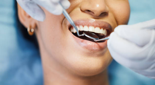 Best Lost Filling or Crown Replacement in North Laurel, MD