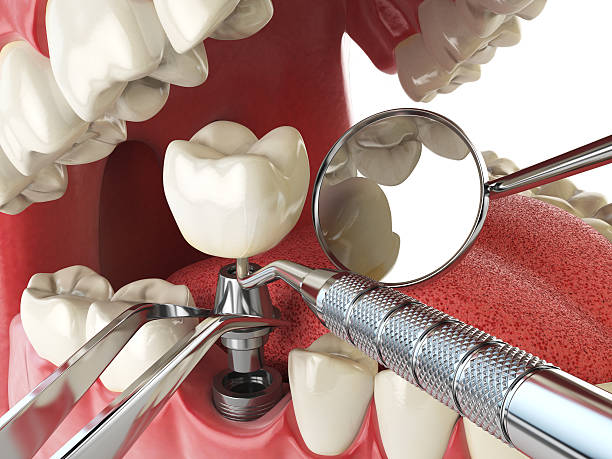 Best Knocked-Out Tooth (Avulsed Tooth) Treatment in North Laurel, MD